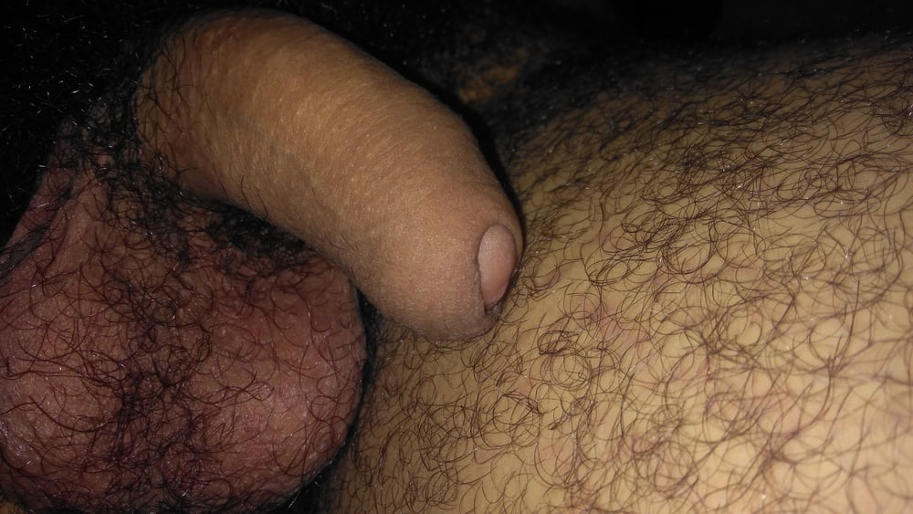 Kissing nevus of the penis
