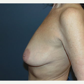 Saggy breast 65-74 - 40 Pics 