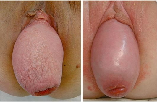 UTERINE PROLAPSE 105 Pics XHamster