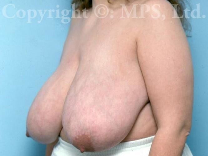 Breast reduction surgery after mastectomy-3833