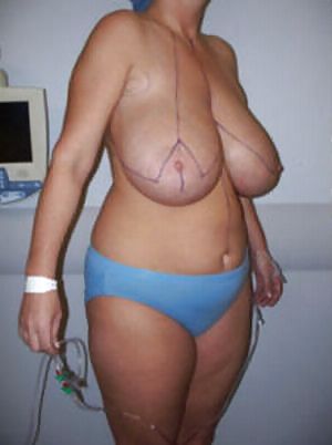 Big Natural And Saggy Tits Pre-OP Pictures porn gallery