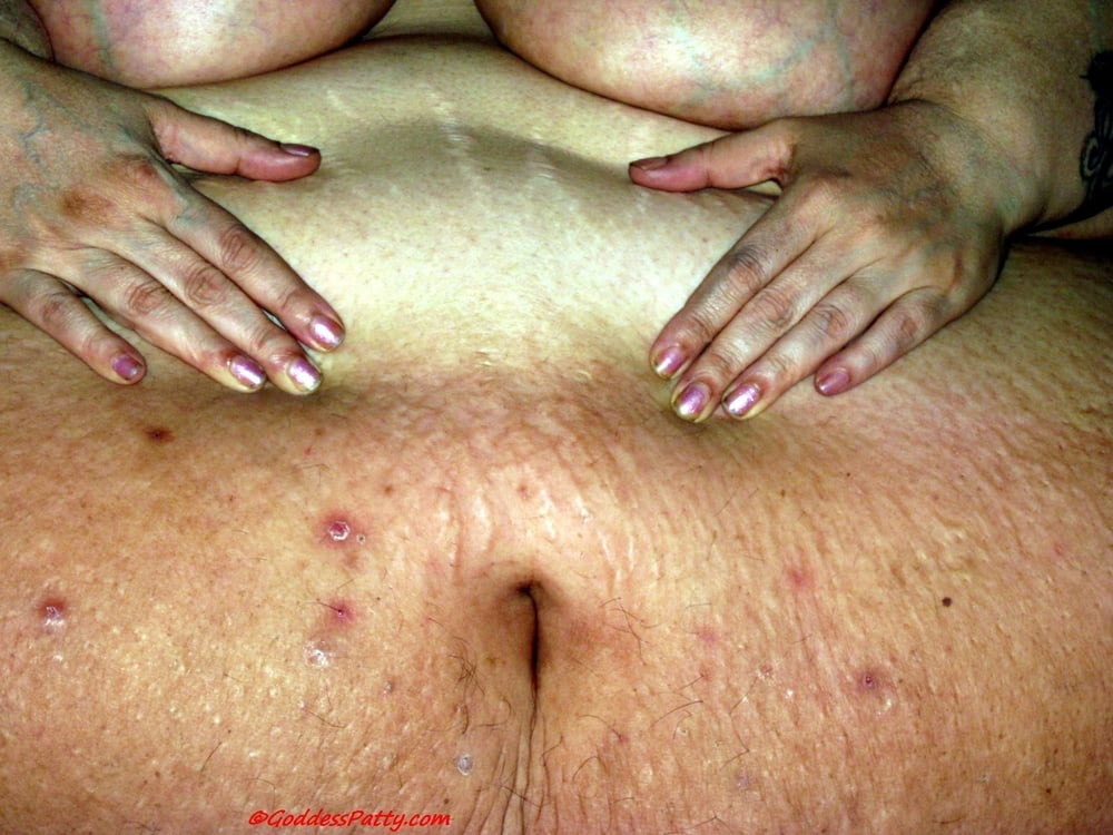 Ssbbw Reality Discolored Skin Scars Bedsores Acne Photos Xxx Porn Album